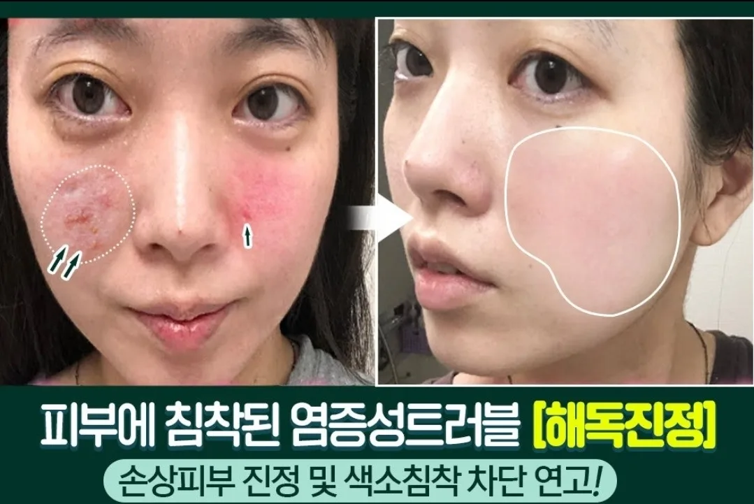 까레넬 새살솔솔 염증시카크림 용량업 40ml