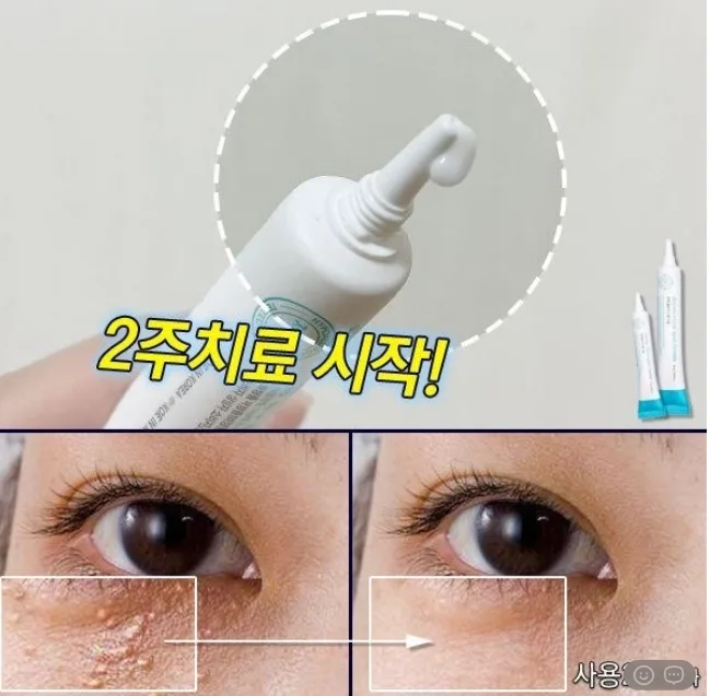 상품코드 : DD004 담다다담 쥐젖 크림 더마클리어스팟크림_20ml (카톤발주용)