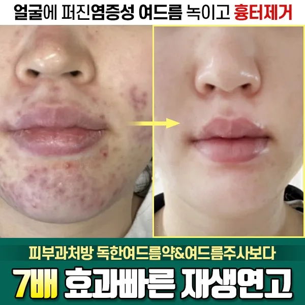 까레넬 새살솔솔 염증시카크림 용량업 40ml