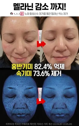메디필 기미 멜라논엑스크림