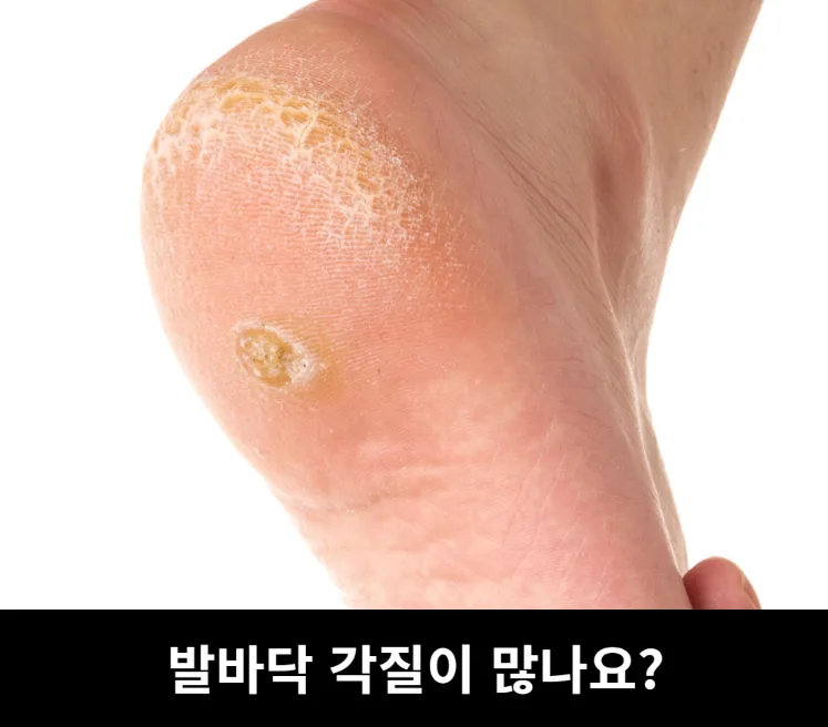 상품코드 : H3922 [아케이] 리빙 안티폴루 풋브러쉬