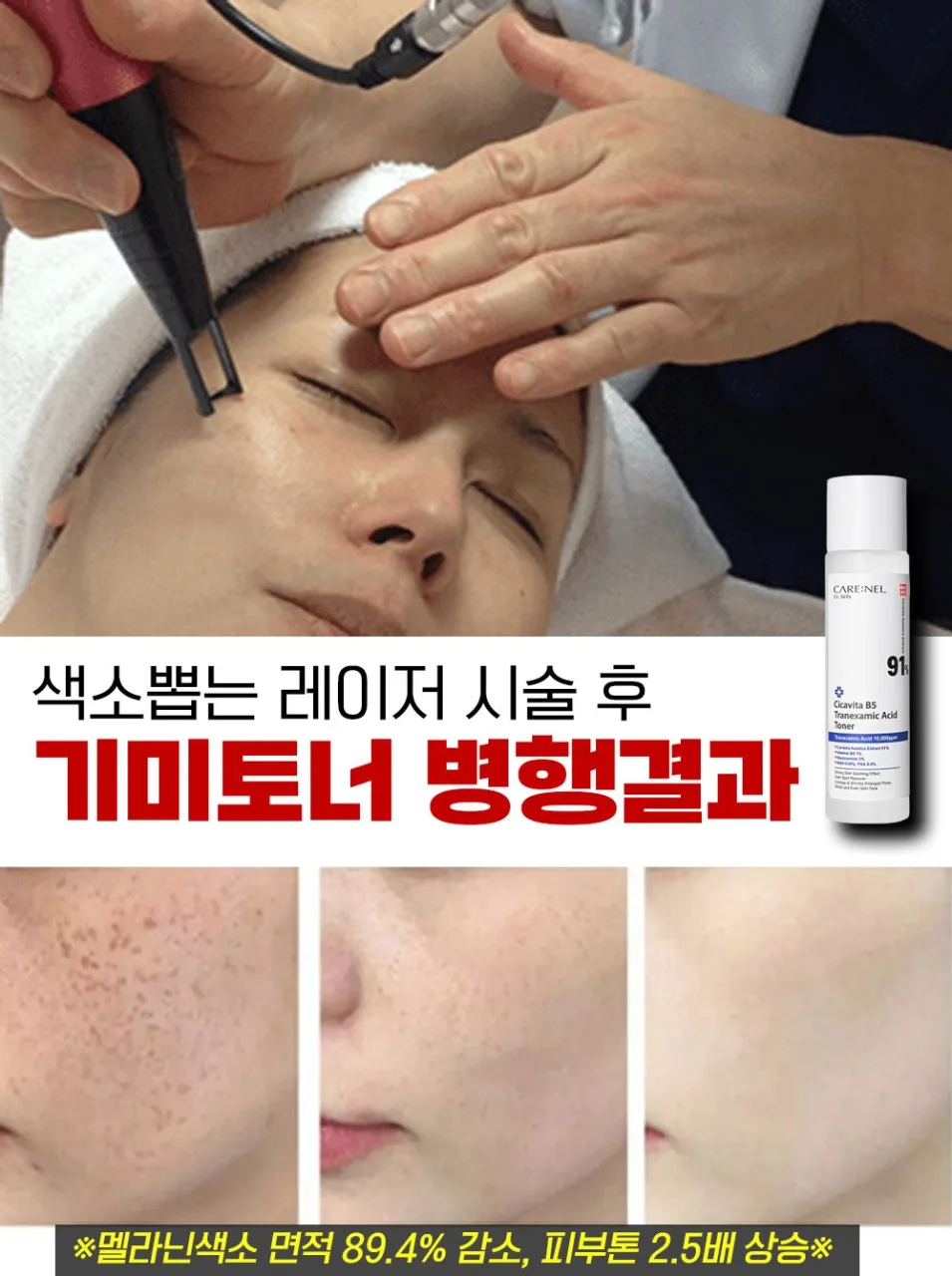 잡티스케일링 기미제거 91% 엑기스토너 155ml