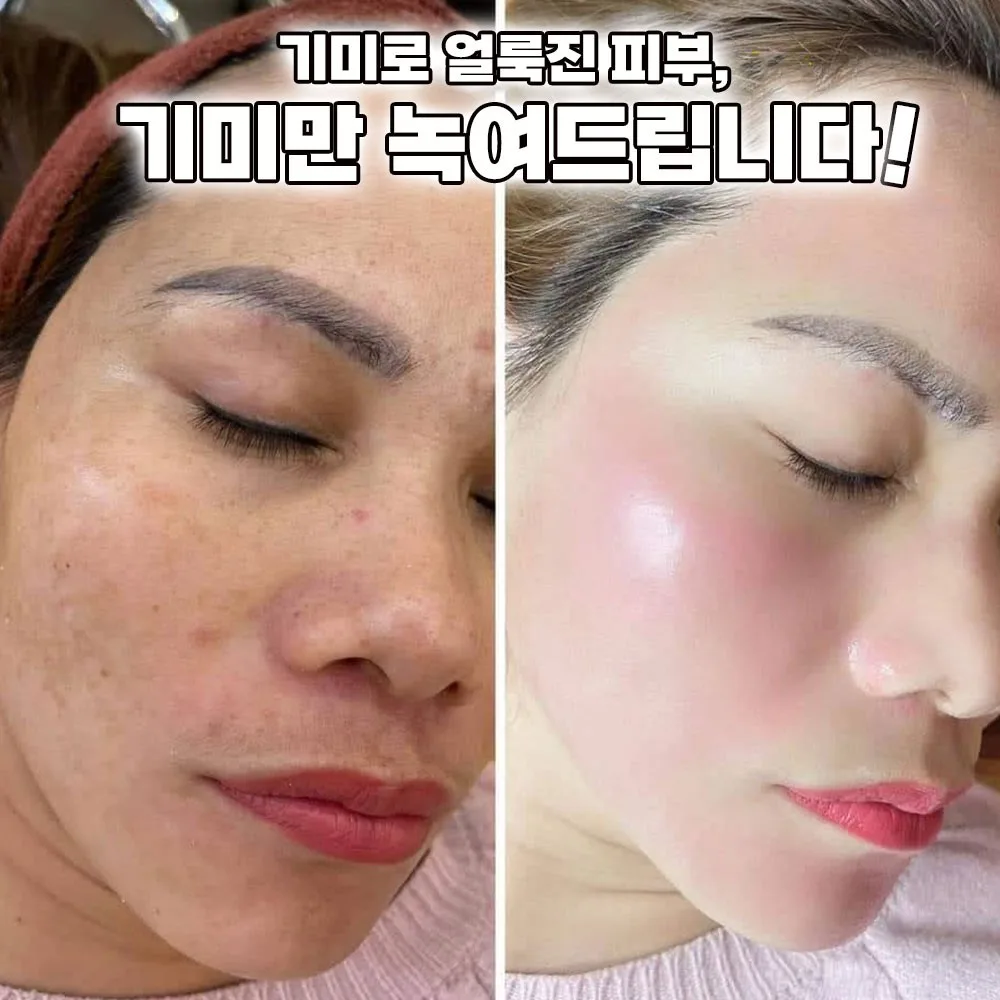 잡티스케일링 기미제거 91% 엑기스토너 155ml