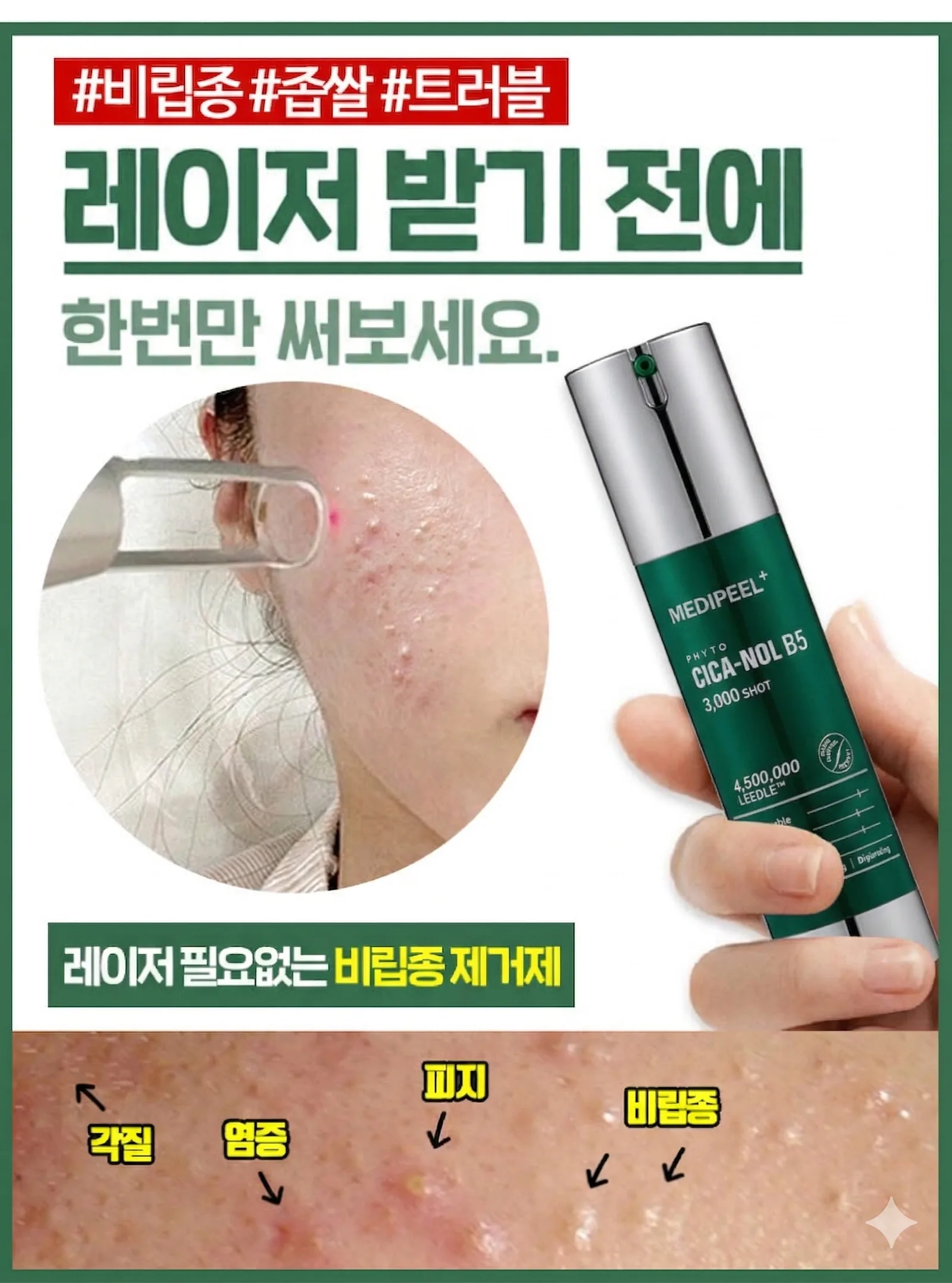 메디필 피토시카재생 비립종 3000샷