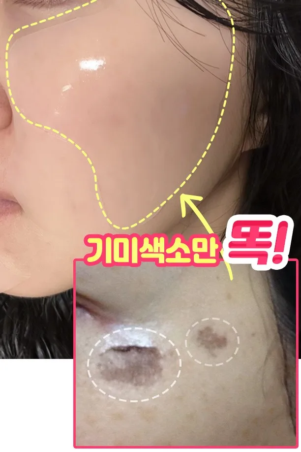 기미색소떼어내는! 대용량 멜라토닝 기미패치