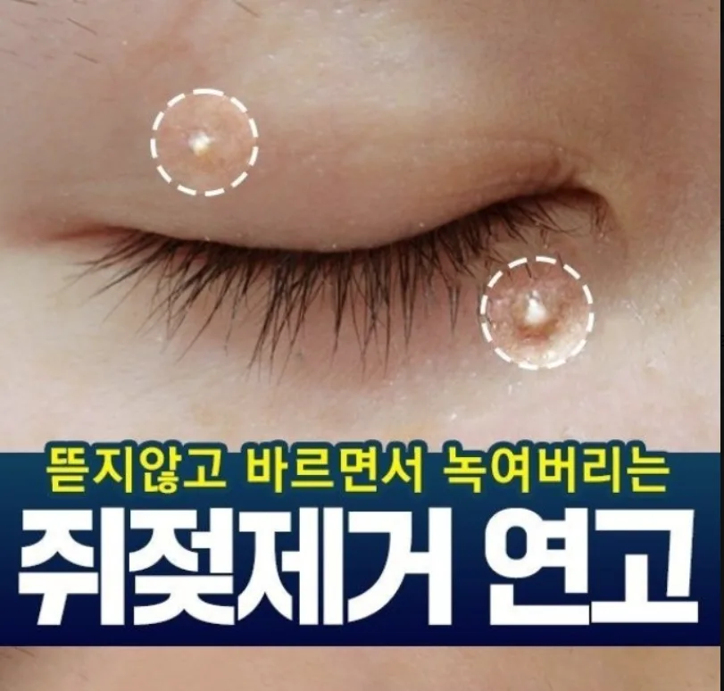 담다다담 쥐젖 크림 더마클리어스팟크림_20ml (낱개발주용)